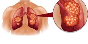 primeiros sintomas do cancer de pulmao