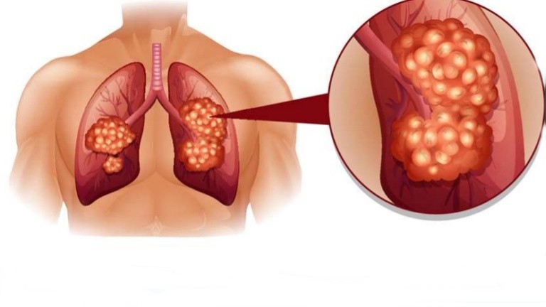 primeiros sintomas de câncer de pulmão
