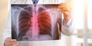 principais sinais e sintomas de pneumonia