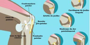 causas da dor no joelho