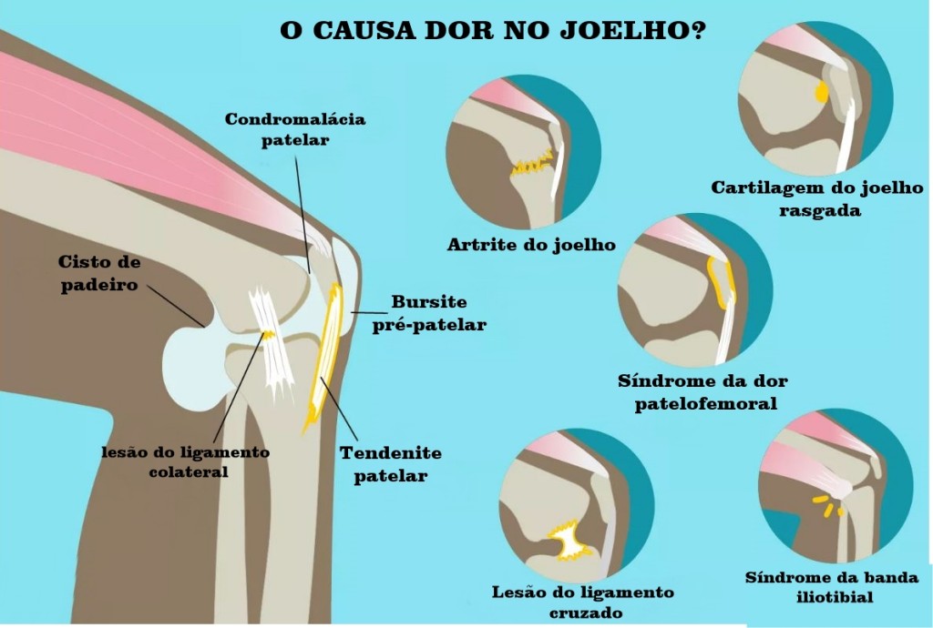 causas da dor no joelho