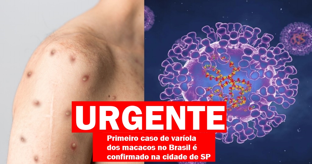 Varíola dos macacos no Brasil